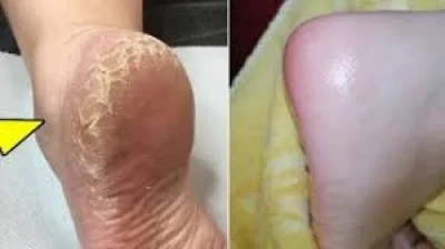 لا إحراج بعد اليوم... تخلصي من تشققات القدمين وأحصلي على نعومة الحرير بحيلة بسيطة جداً.. طبقيها فوراً