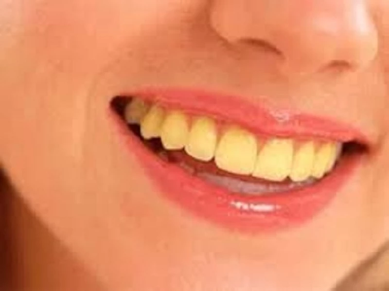 "اكتشف طرق مذهلة للتخلص من جير الأسنان واستعيد ابتسامتك الجميلة"
